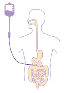 sonde jejuostomie